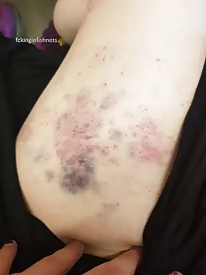 pics bruises porn